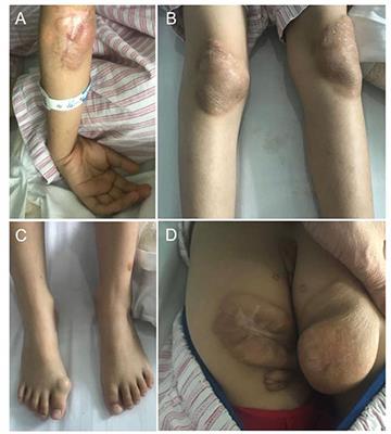 Sitosterolemia With Atherosclerosis in a Child: A Case Report